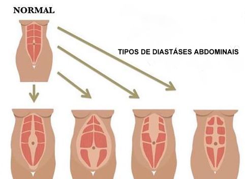 tipos-de-diastase