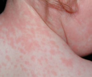 Roseola Macetes De Mae