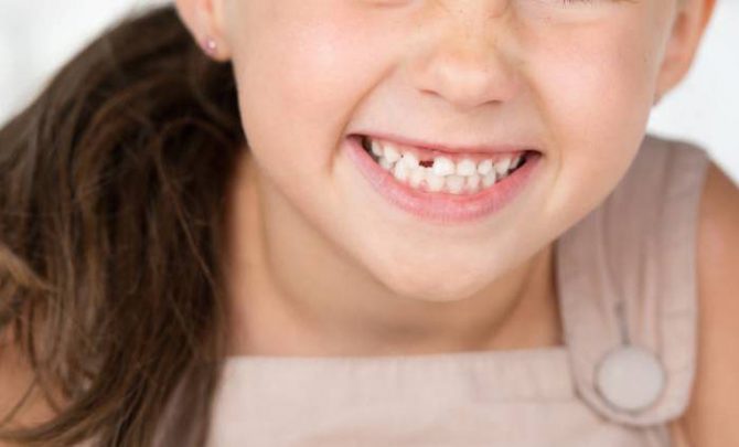 Dente de leite mole