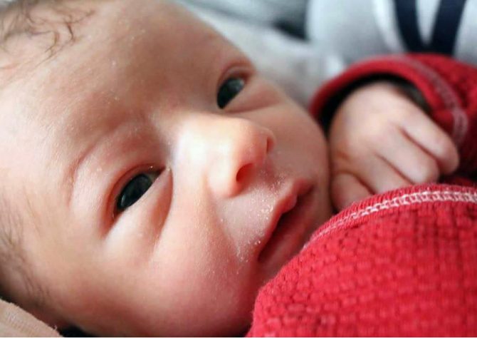 Ictericia Neonatal