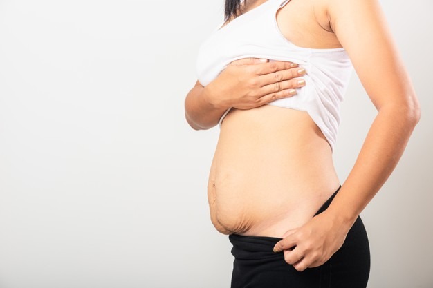 Flacidez pós-parto