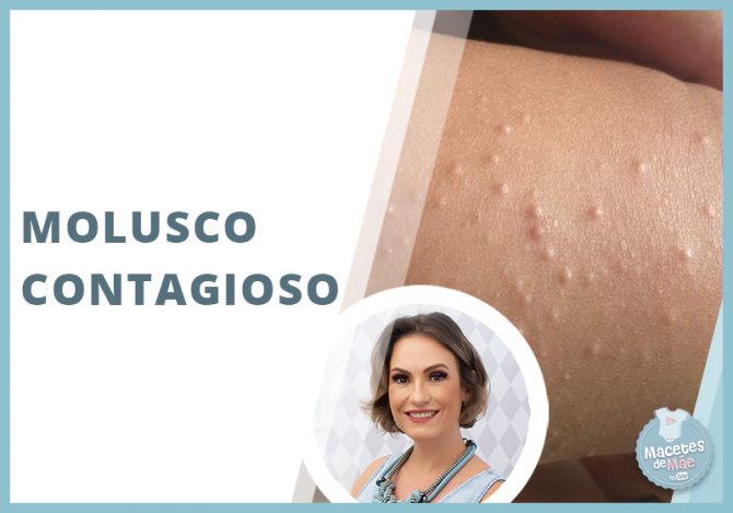 molusco contagioso